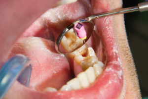 Hémorragie Dentaire : Conseils - Centre Dentaire Voltaire