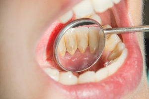 Carie dentaire: de la formation de la plaque dentaire à l'infection