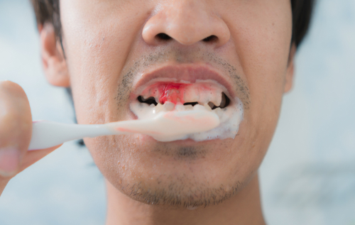 hemorragie dentaire pourquoi ce sang et comment reagir